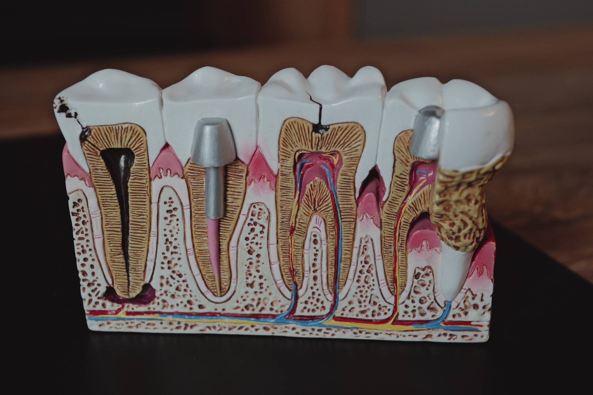 Vytržení osmiček v Kittler Dent – odborná chirurgická péče v Liberci