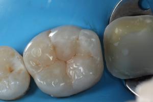 Nová výplň podle principů biomimetic dentistry