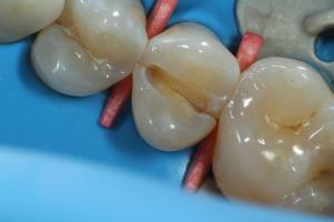 Zjištěna fraktura kořene, jediná možná léčba je extrakce a imediální implantace.